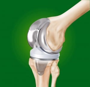 1. knee replacement.jpg