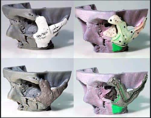 3d printed surgical models