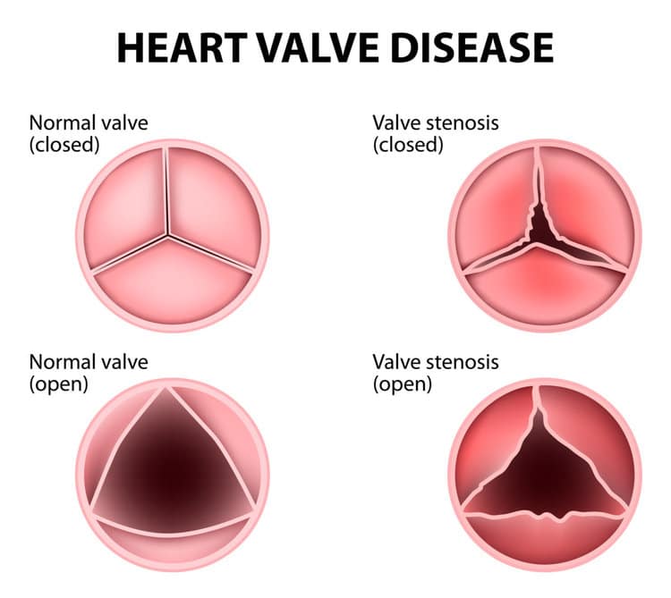 Heart-Valve-Disease-allevi blog.jpg