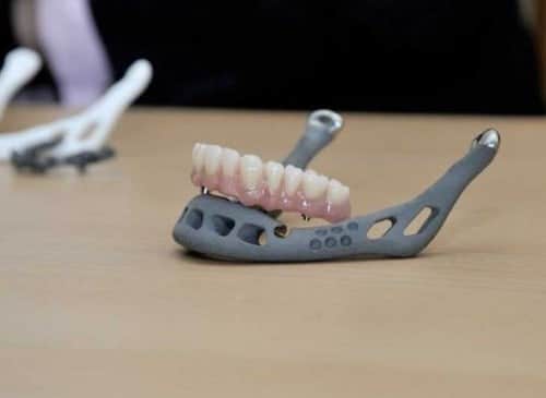 3d printed dental implants